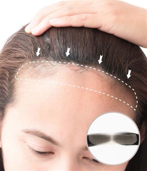 hair patch for women